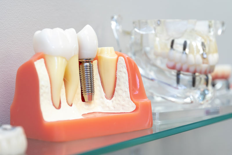 dental-implant-model