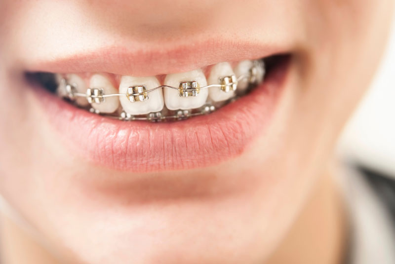 dental patient wearing braces
