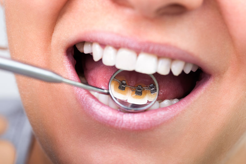 dental patient with lingual braces