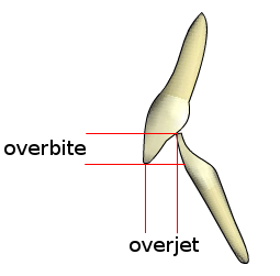 Underestimating Your Overbite?