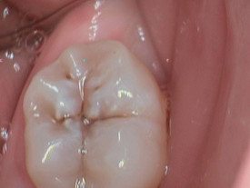Damaged Tooth