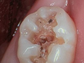 Tooth Needing extraction