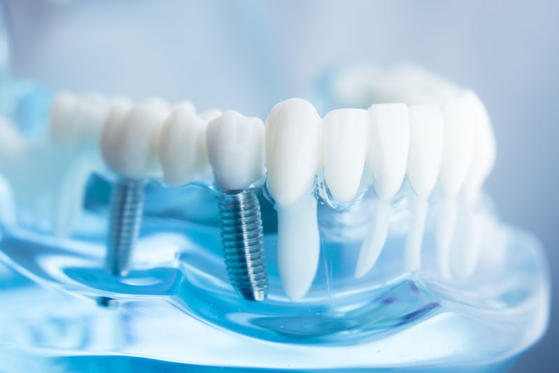 Making the Most of Your Dental Implants!