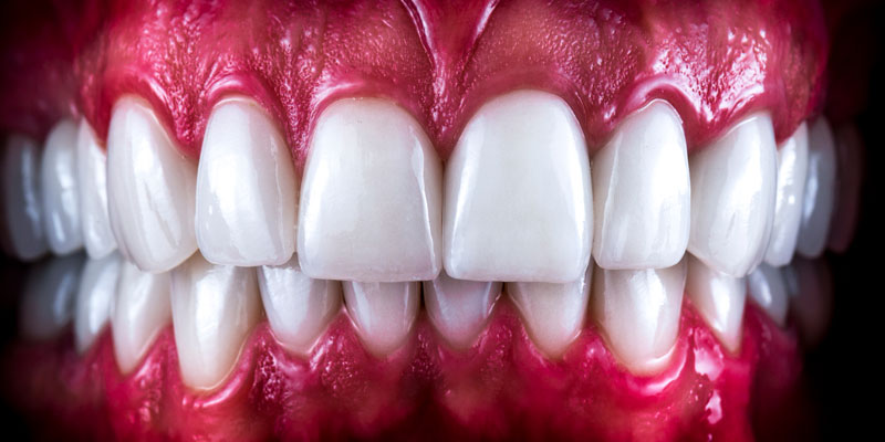 What Are Full Mouth Dental Implants?