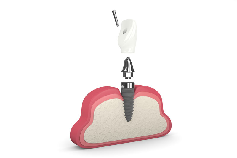 What Are The Benefits Of Dental Implants?