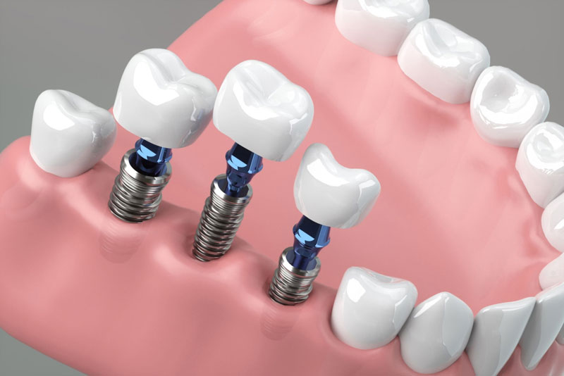 How Many Teeth Can Dental Implants Replace?