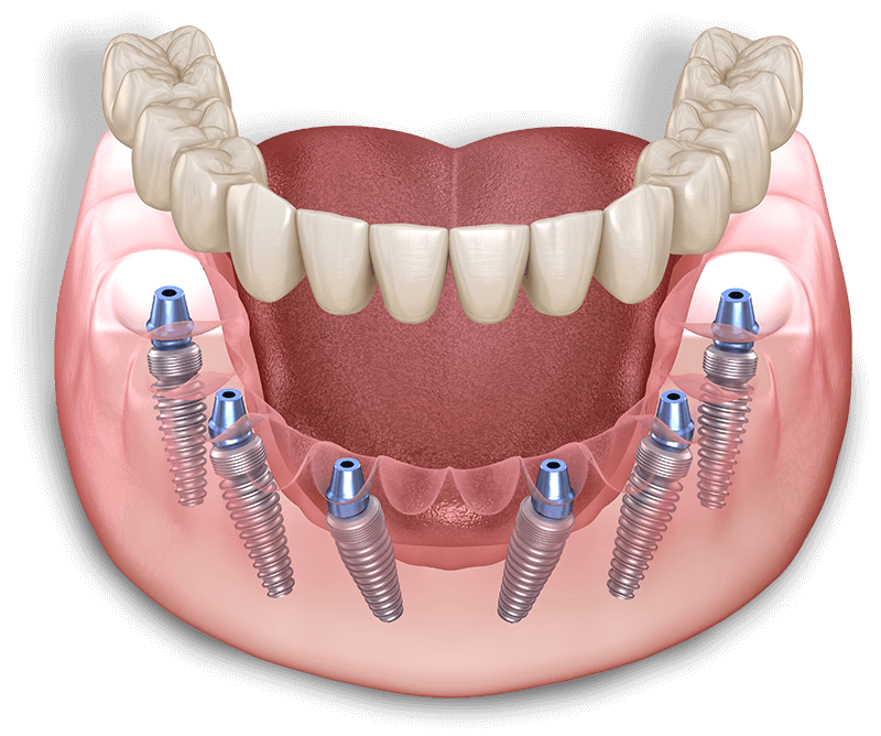 Imgi 15 Full Arch Dental Implant Model